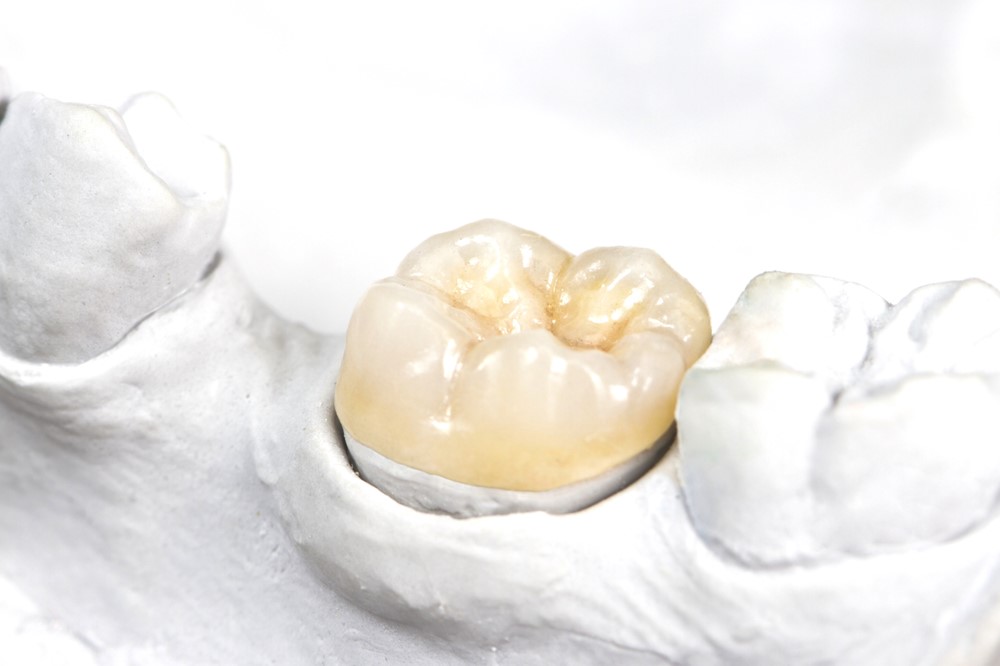 メタルフリー治療とは