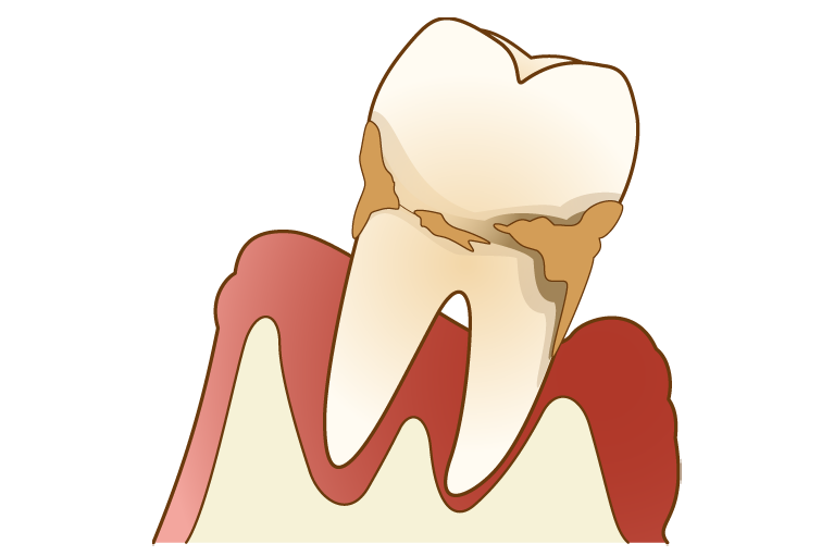 歯周病治療の重要性